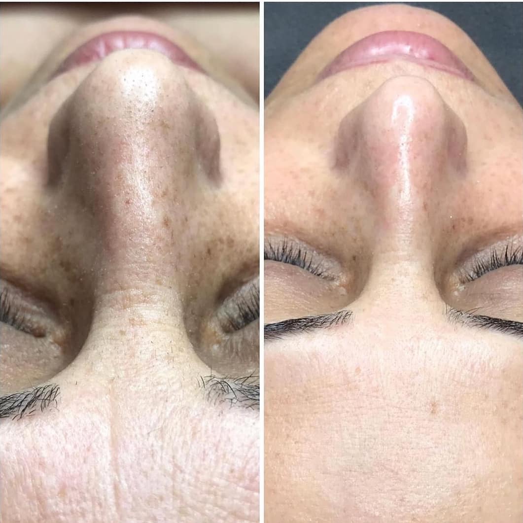 Молочный пилинг для лица в домашних условиях, отзывы