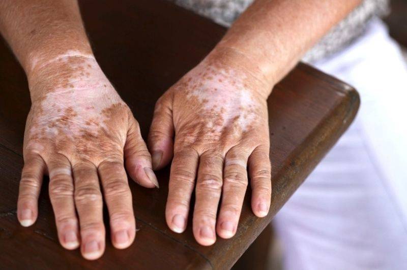 Пигментация кожи и лечение пигментных пятен на лице - причины появления пигментации, способы и виды её лечения, народные средства и секреты по маскировке пигментных пятен