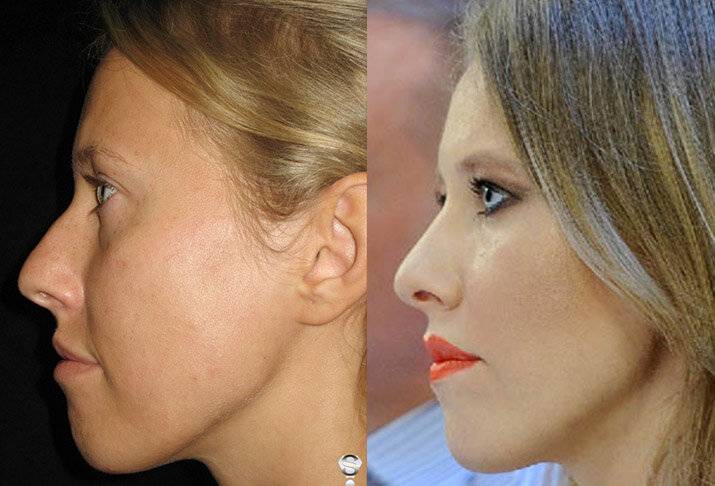 Ринопластика кончика носа: самая популярная операция (2021)