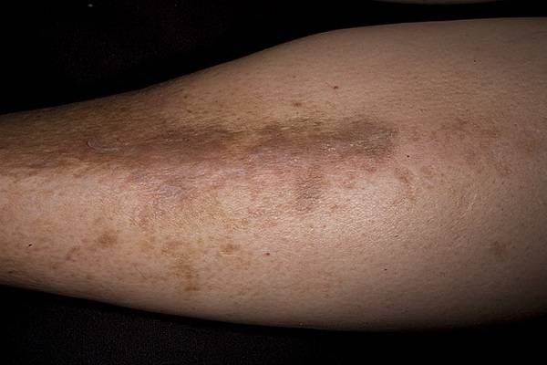 Коричневые пятна на ногах: сведения и причины, способы лечения мужчин и женщин, профилактика пигментации кожи