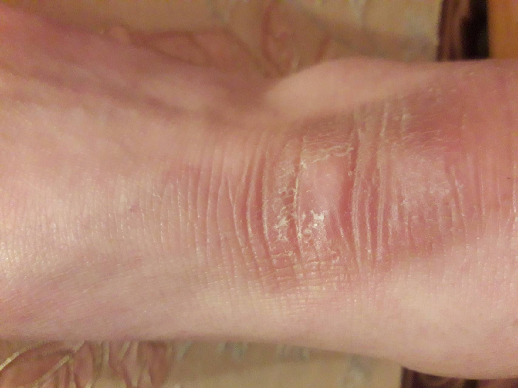 Сухая кожа на ногах: симптомы, причины, лечение