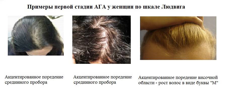 Выпадение волос у девушек