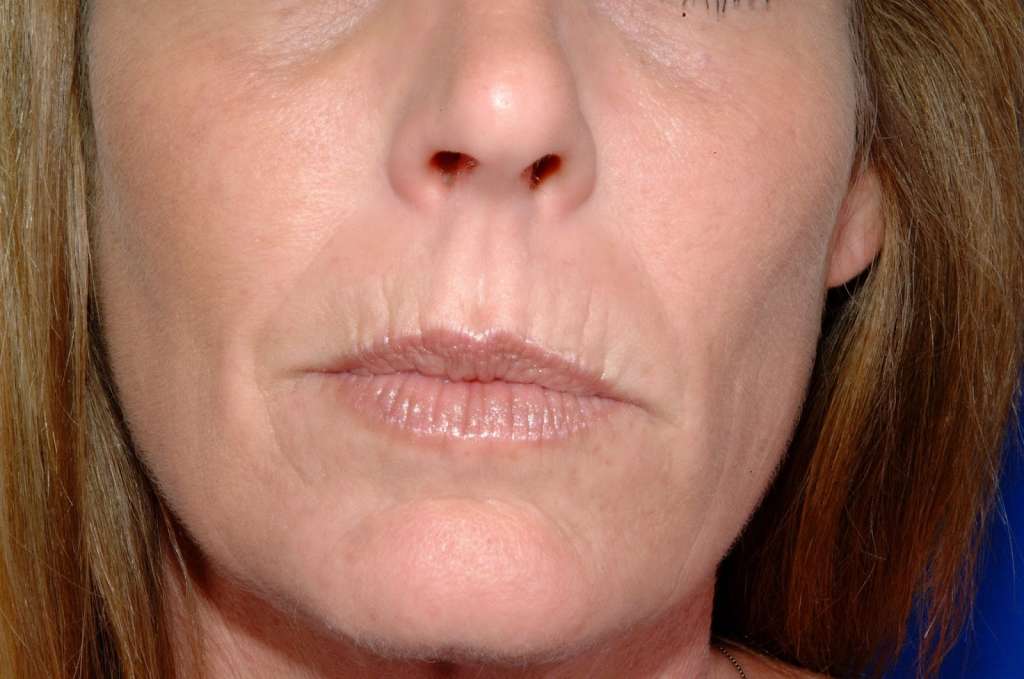 Как убрать мимические морщины вокруг глаз, рта и на лбу? совет как с ними бороться в домашних условиях +фото