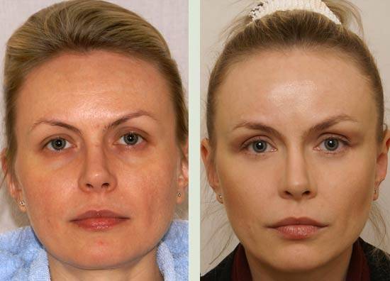 Эндоскопический лифтинг лица: эффективная подтяжка средней и нижней трети лица