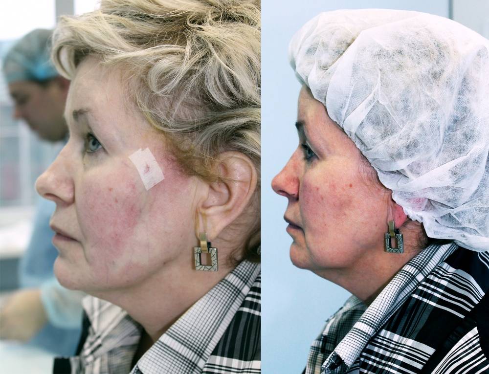 Нити аптос для подтяжки лица: описание, проведение процедуры, реабилитация