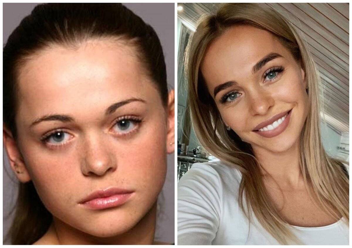 Анна хилькевич до и после пластики - фото до и после операций