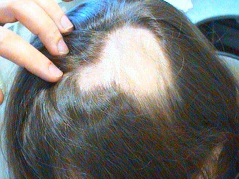 Почему выпадают волосы на голове у мужчин и женщин