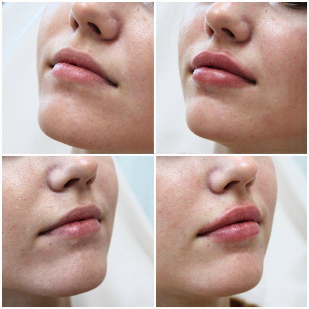 Парижские (французские) губы: техника увеличения, фото до и после