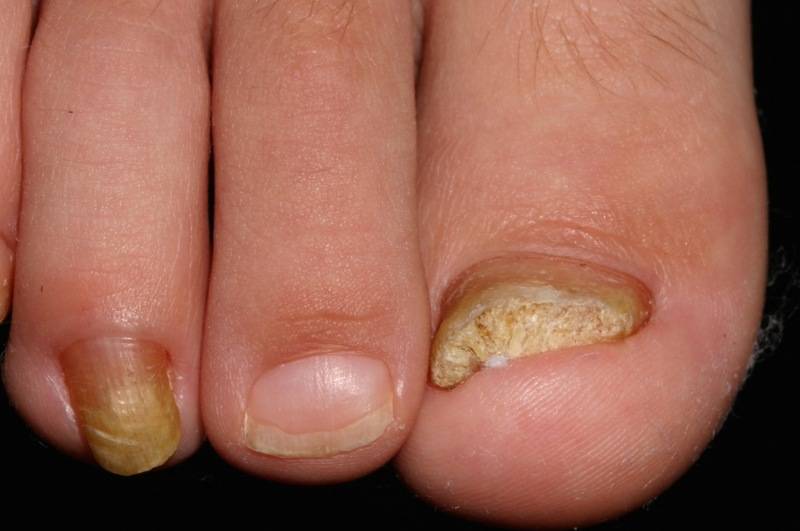 Как выглядит грибок ногтей на ногах фото