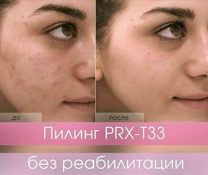Prx t33 пилинг отзывы * рекомендации врачей и косметологов, фото до и после с официального сайта