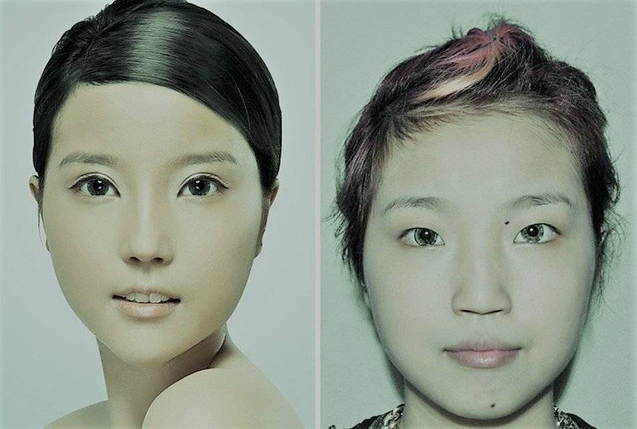 Внешность людей до и после пластики по увеличению глаз или существенен ли эффект – разбираемся