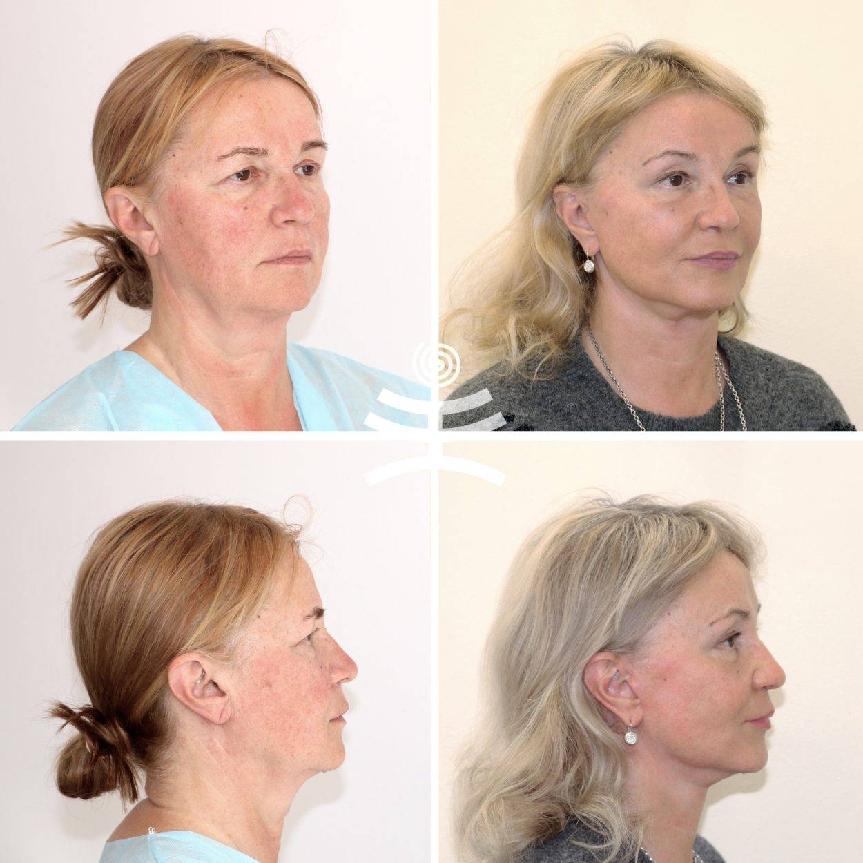 Эндоскопическая подтяжка лба: что это, возможные последствия, фото до и после, отзывы