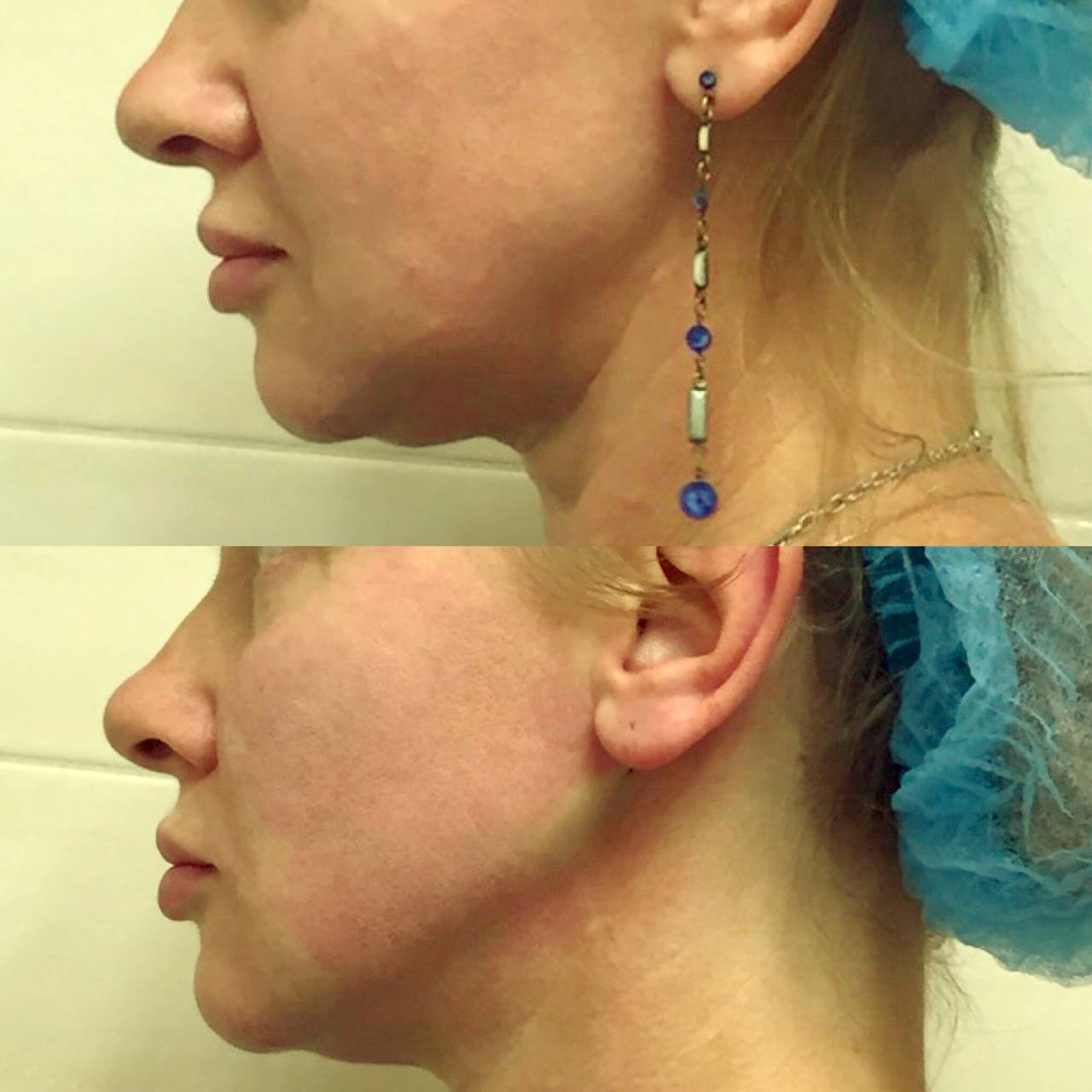 Корейские мезонити коги для подтяжки лица