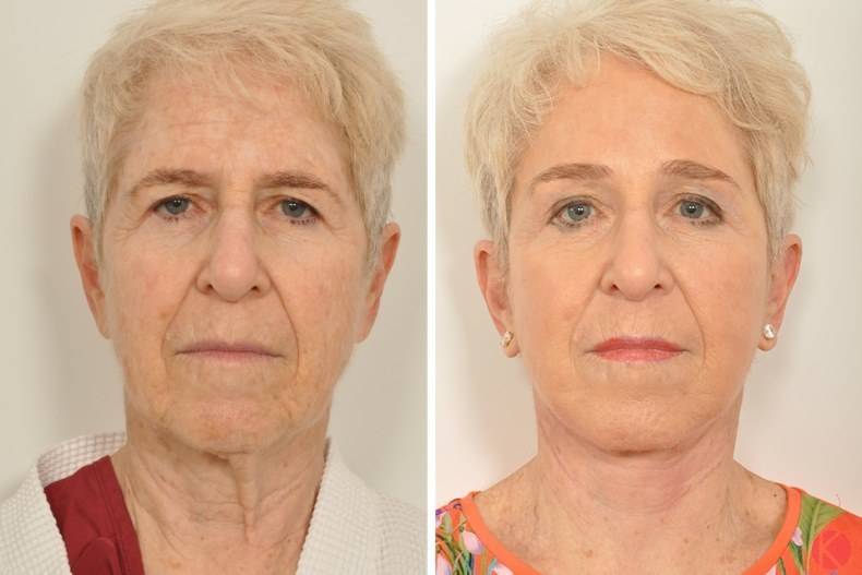 Ритидэктомия кожи лица и шеи что это