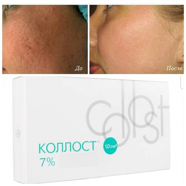 Келоидный рубец – фото, мазь от рубцов, лазерная шлифовка