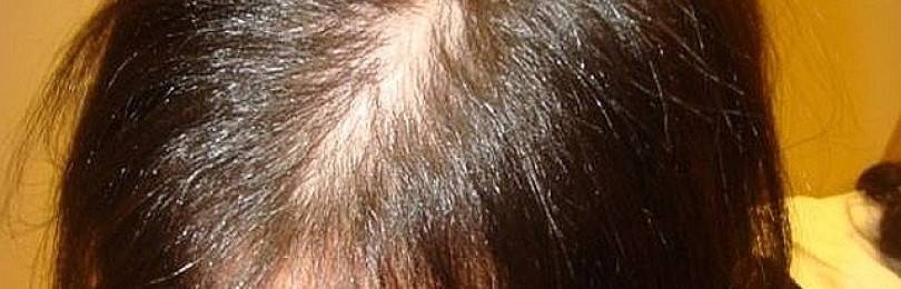 Основные причины выпадения волос на голове у подростков девочек и мальчиков. что делать в данной ситуации?