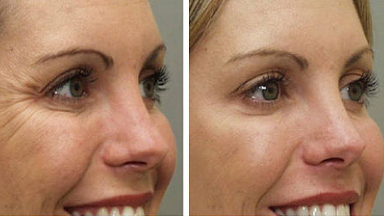 Убрать морщины вокруг глаз косметология фото до и после