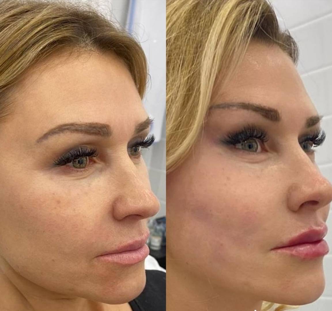 Нитевой лифтинг подбородка и 9 других зон на лице: подтяжка контура овала лица, лифтинг век и кожи вокруг глаз, лба и бровей, верхней губы