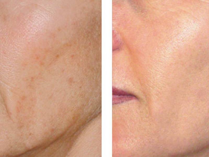 11 кислотных пилингов для домашнего и салонного применения