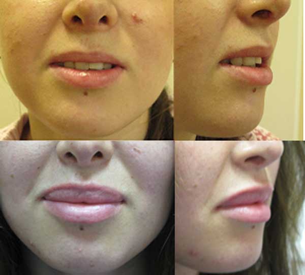 Красивые губы с помощью контурной пластики — легко! особенности, техника введения филлеров и уход