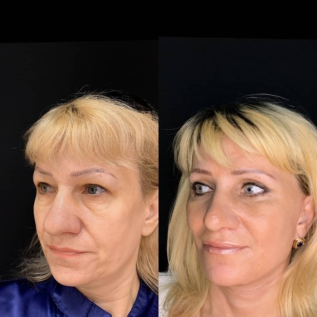 Подтяжка лица фейслифтинг фото до и после