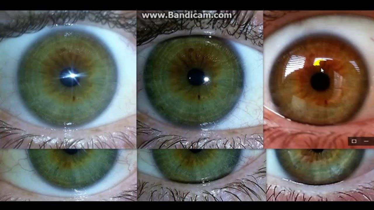 Из карих глаз в голубые операция до и после фото
