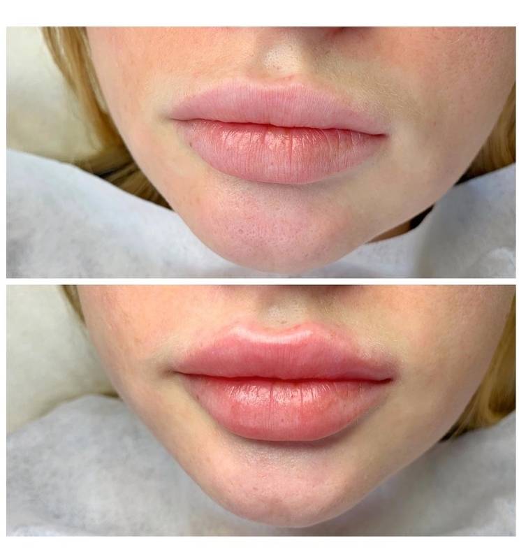 Биоревитализация губ до и после. Увеличенные губы вблизи. Увлажнение губ биоревитализация.