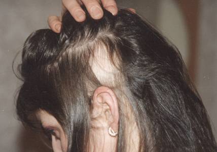 Выпадение волос при беременности: причины и лечение