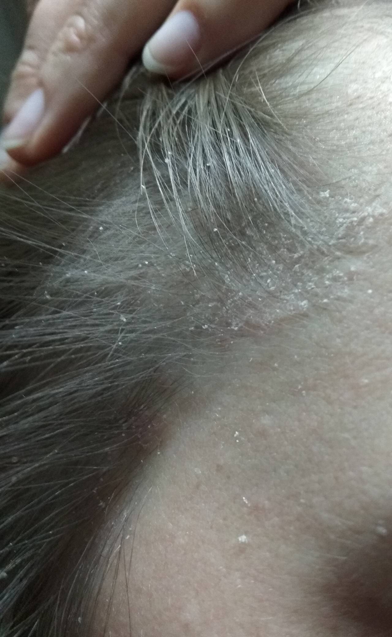 Почему шелушится, чешется кожа на голове: причины, методы лечения