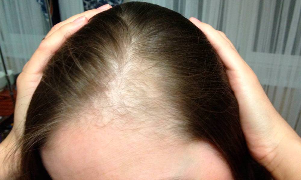 Выпадение волос при беременности на ранних сроках: причины и методы лечения
