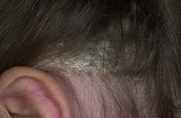 Шелушение кожи головы — причины, способы лечения. эффективность и опасность народных средств от шелушения кожи головы