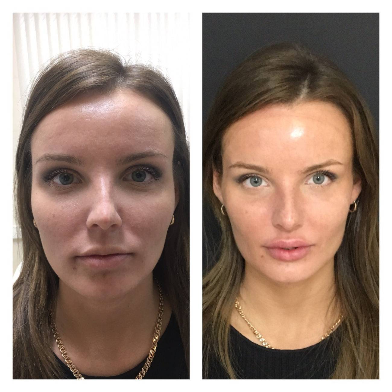 Радиез косметологический фото до и после