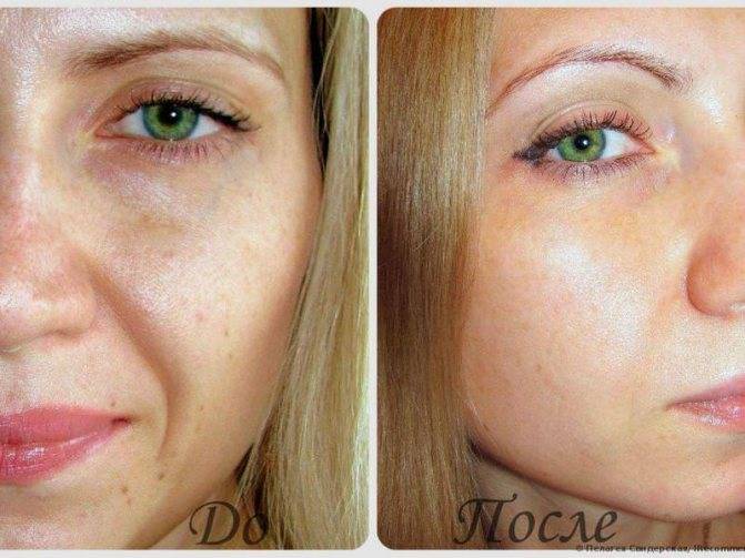 Микротоки при куперозе и розацеа; что является противопоказанием - наличие кардиостимулятора, насморк, гайморит, щитовидная железа, беременность, период лактации, брекеты, менструация; какие могут возникнуть побочные эффекты: рак, сыпь и отеки на лице