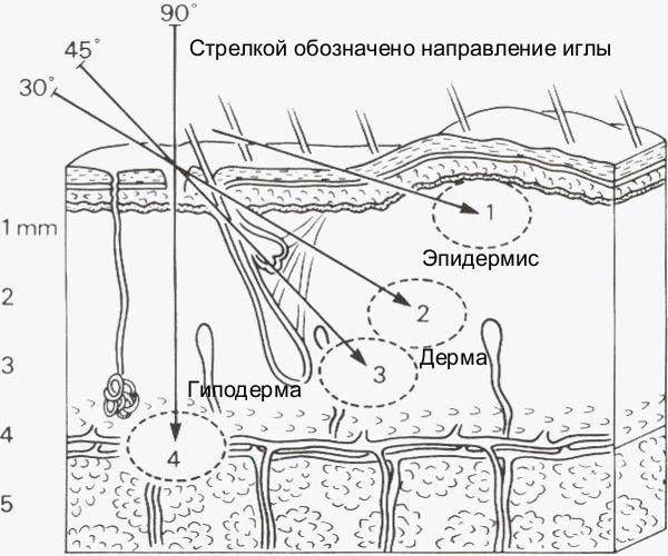 Напаж в мезотерапии * папульная техника, микропапульная, схема уколов
