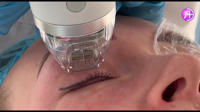 Scarlet rf лифтинг в клинике "идеал" по специальной цене с лучшими специалистами москвы!