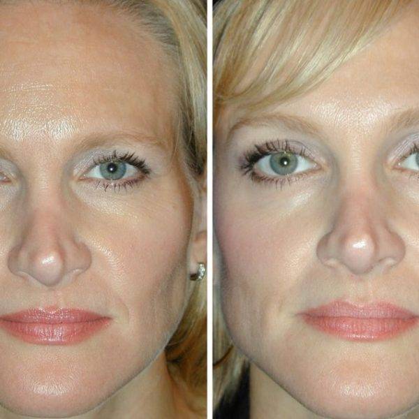 Как убрать филлеры под глазами, можно ли удалить лидазой