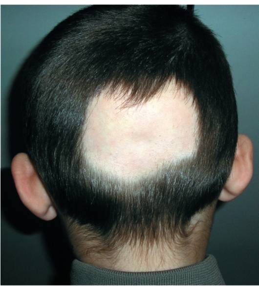 Причины выпадения волос у подростка. Очаговая алопеция офиазис. Гнездная алопеция офиазис.