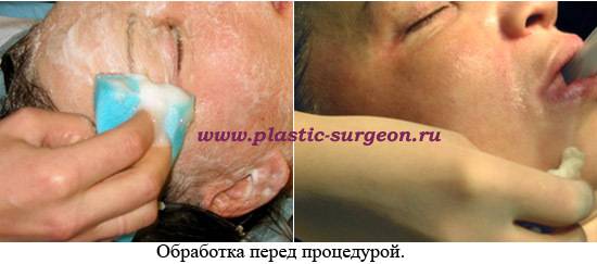 Феноловый пилинг – непредвзятый взгляд изнутри