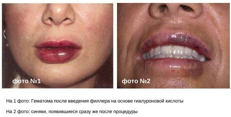 После инъекции филлеров: что нельзя делать, чем мазать губы, как лечить, если появились отек, гематома