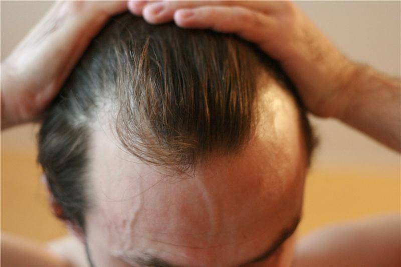 Почему у мужчин не растут волосы на лбу
