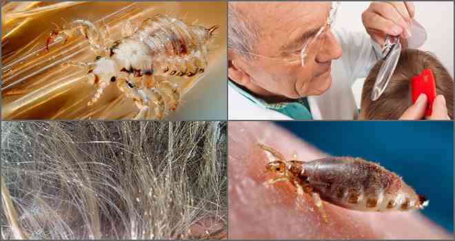 Бельевые вши: описание паразитов, методы избавления