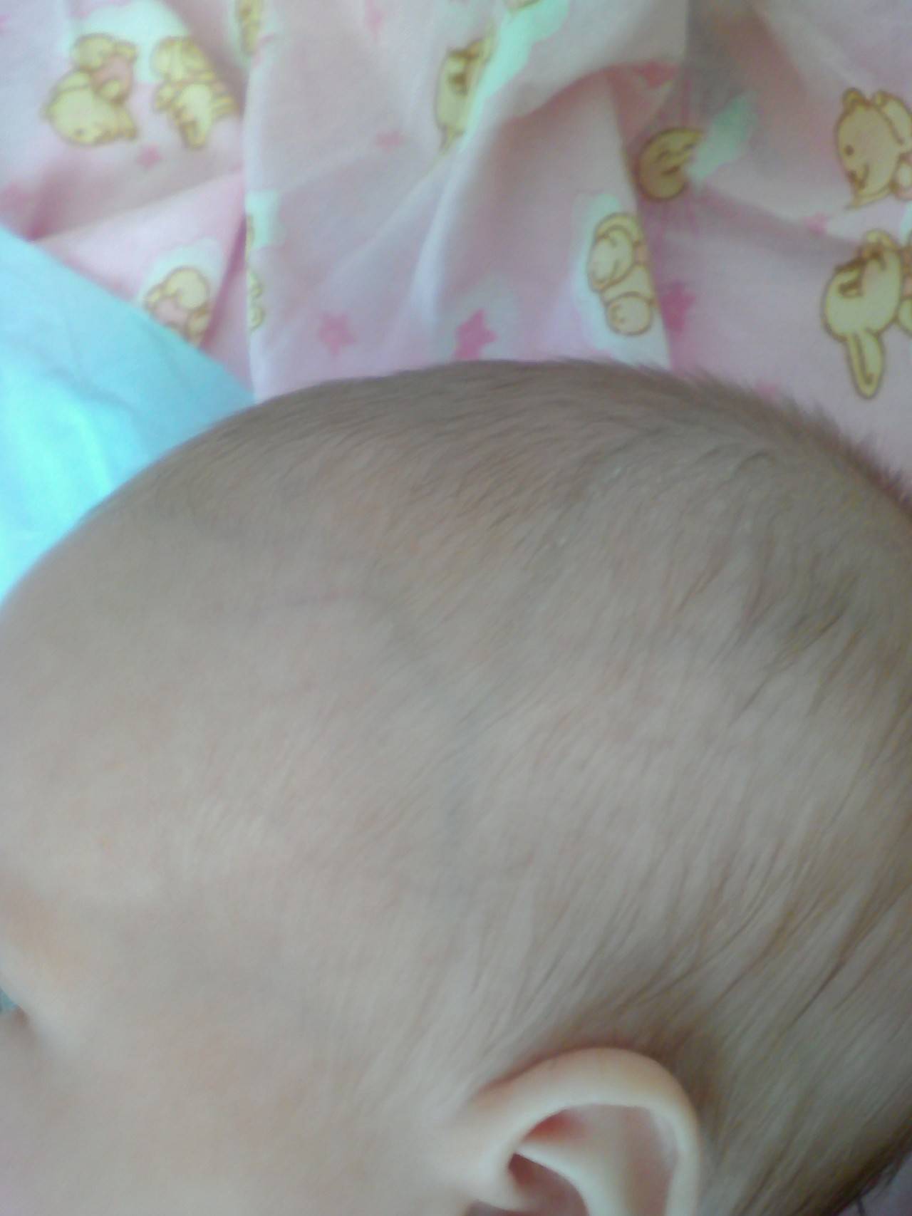 Вены на лбу у ребенка. Затылочная кефалогематома. Грудничок волосы на затылке. Волосы у новорожденных на голове. Шишка на затылке у грудничка.