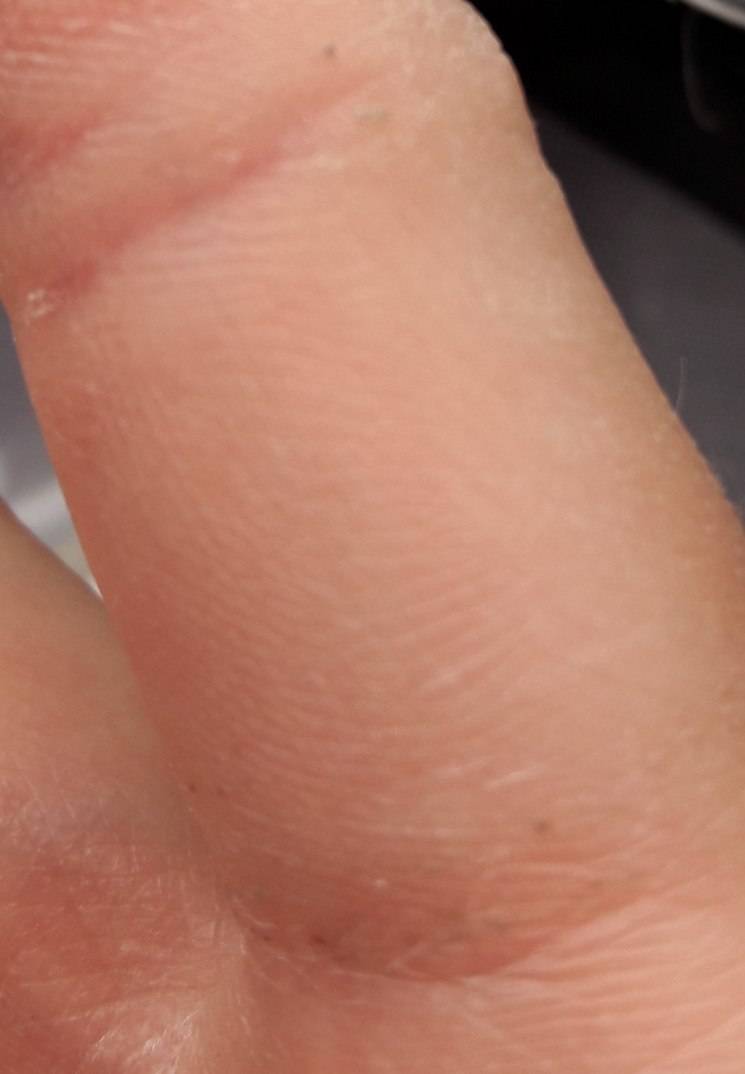 От чего шелушится кожа между пальцев рук