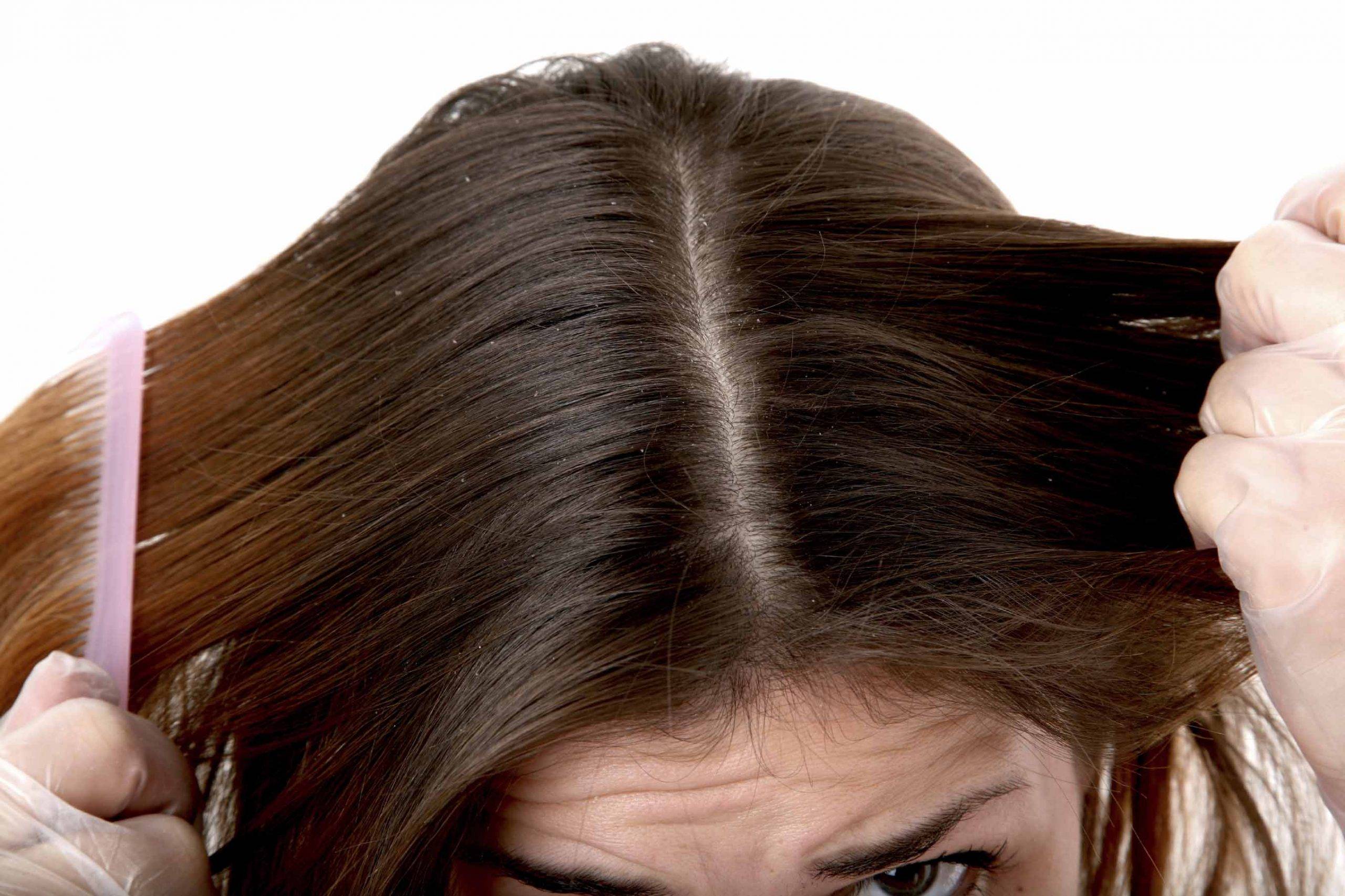 Перхоть и выпадение волос: причины, способы сохранить волосы
