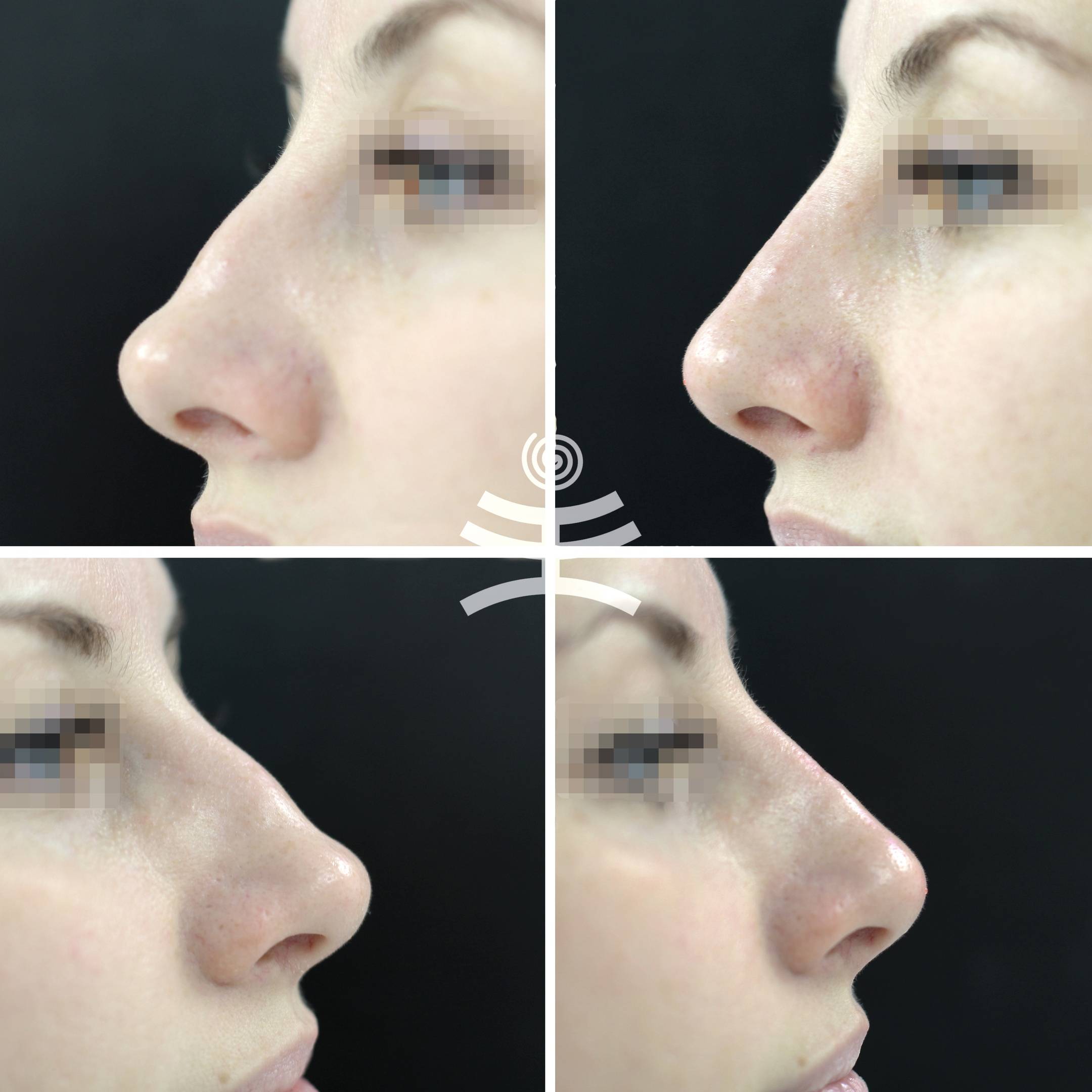 Седловидный нос ринопластика