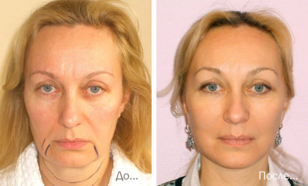 Иглоукалывание для лица как подтяжка фото до и после