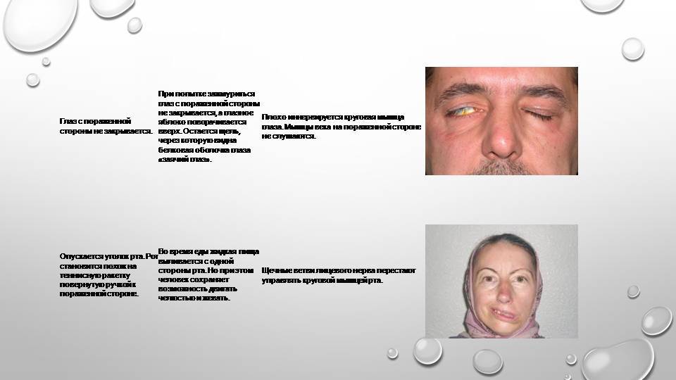 Неврит лицевого нерва симптомы и лечение у взрослых причины фото