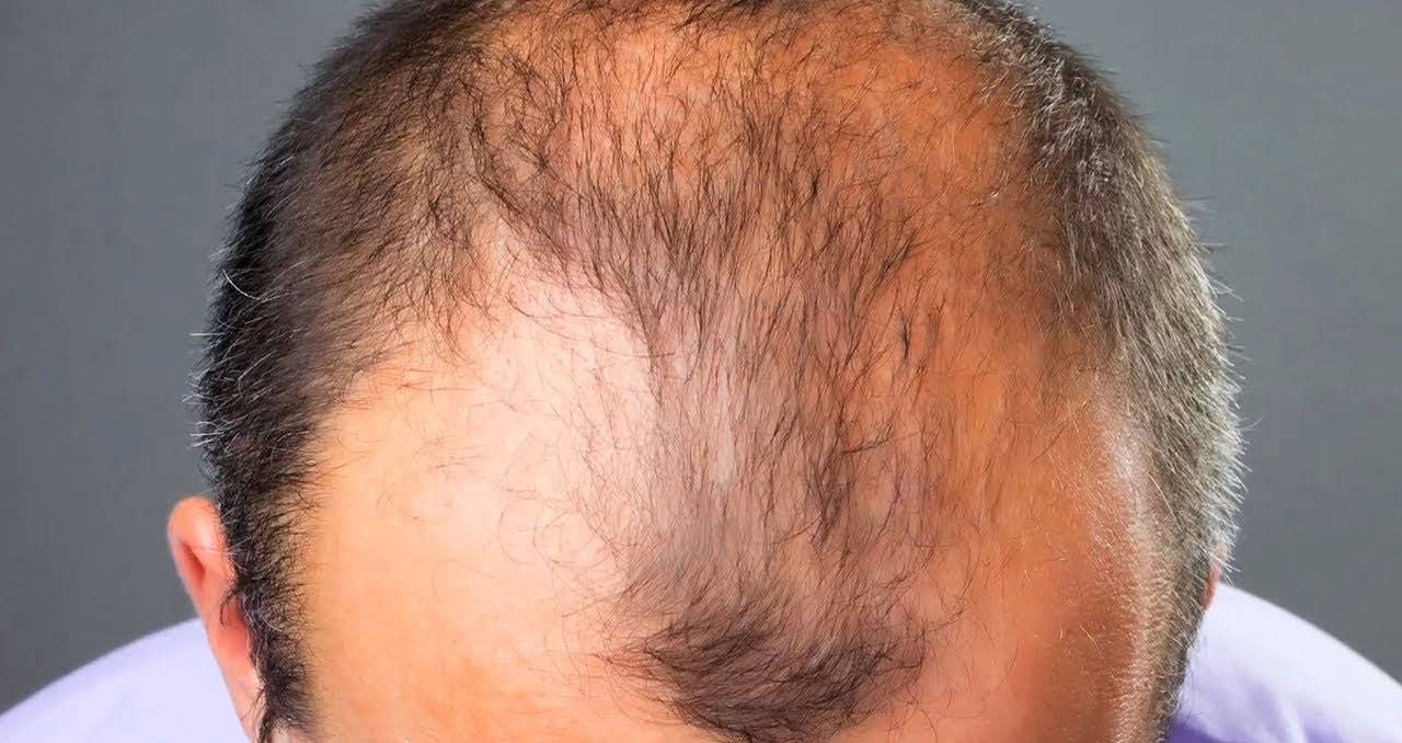 Выпадение волос у мужчин в молодом возрасте: причины, что делать?