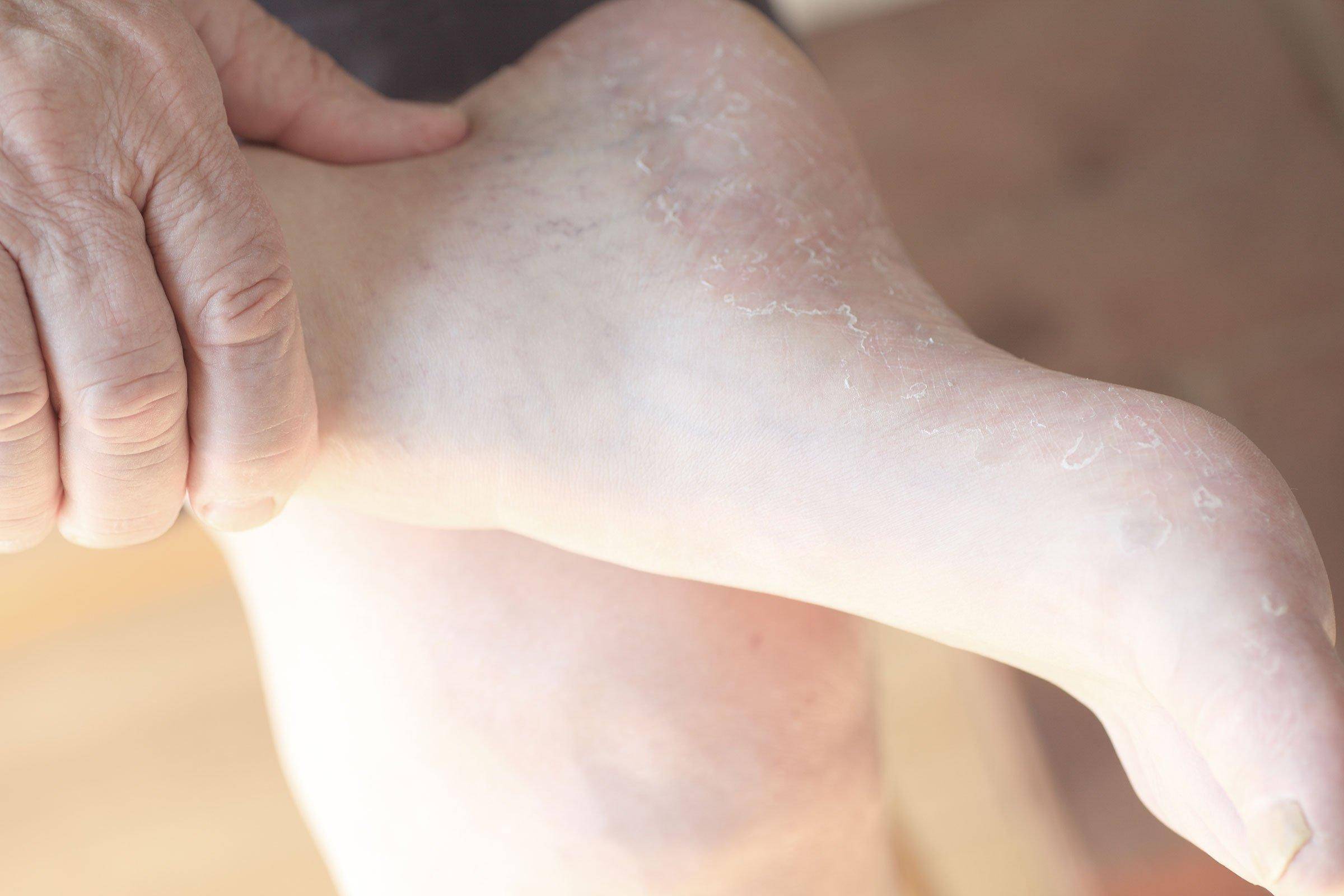 Что делать, если шелушится кожа ног и почему это происходит