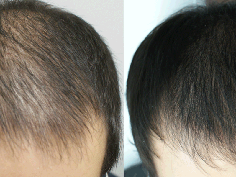 Волосы выпадают после лечения. Мезотерапия для волос. Мезотерапия волос до и после. Мезотерапия волос мужчин. До и после мезотерапии волос.